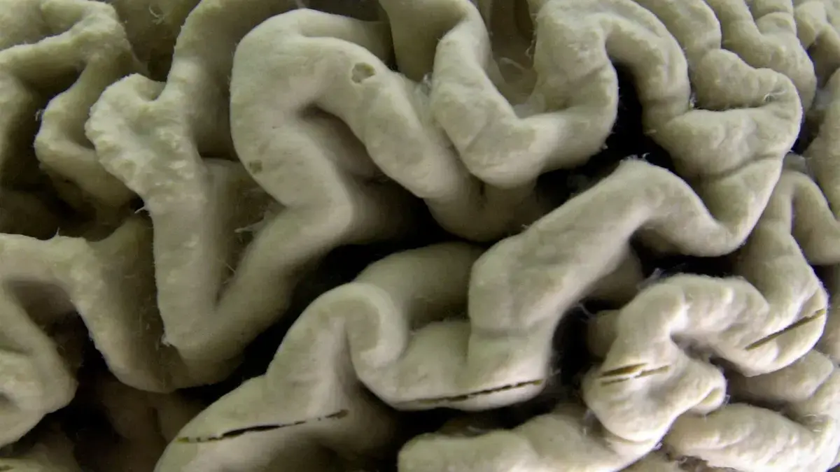 Testul de sânge poate indica un viitor risc de Alzheimer la persoane sănătoase